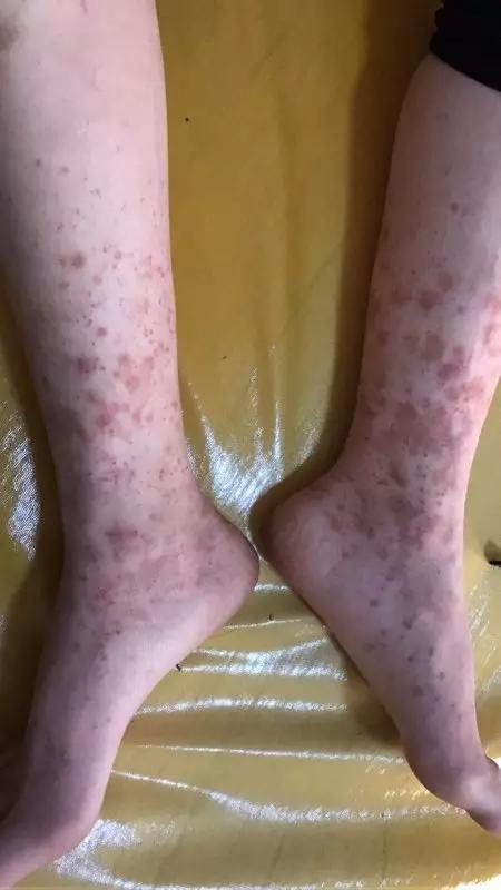 过敏性紫癜危害大，怎样治疗效果好？