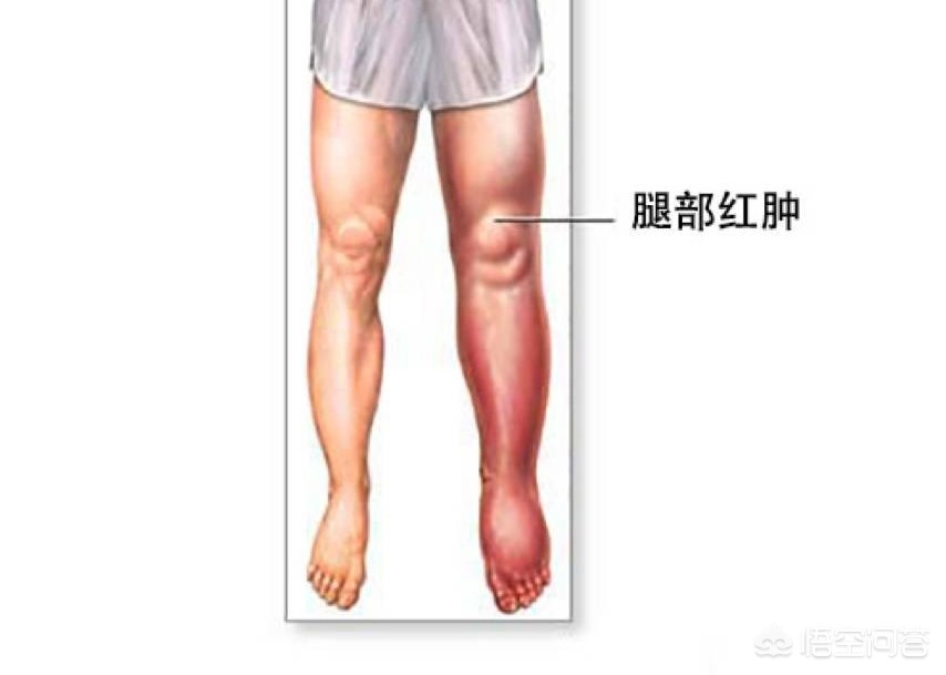 骨折手术后是麻木好还是疼好,骨折术后静脉血栓症状表现