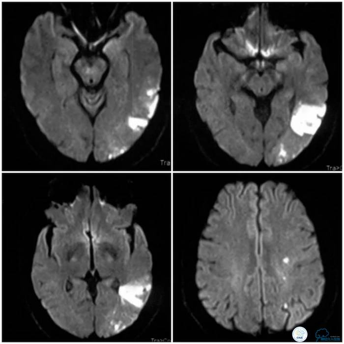 天坛医院脑梗支架,天坛医院做脑基底动脉支架