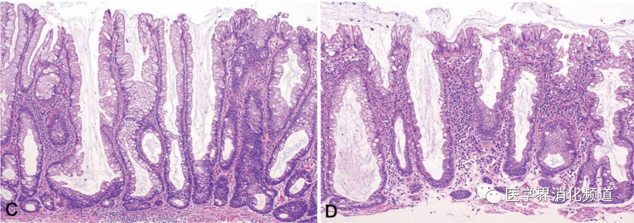 无蒂锯齿状腺瘤是什么,锯齿状腺瘤切除后还会恶变吗