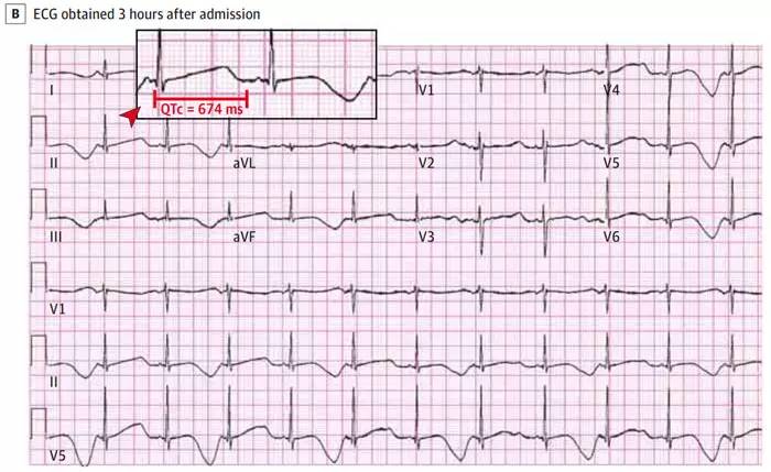 胺碘酮治什么病,胺碘酮这个药是治疗什么的