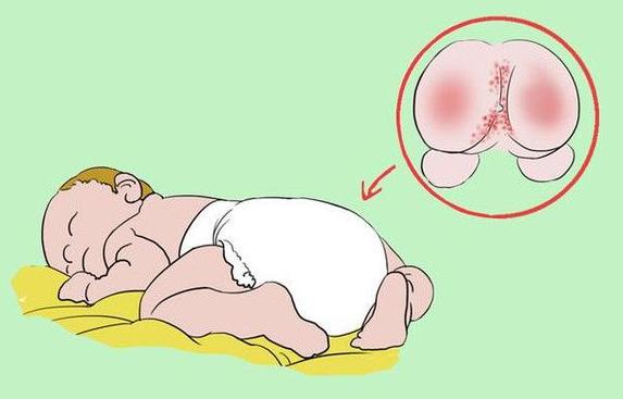 天天兜尿不湿宝宝红屁股了,该怎么办?