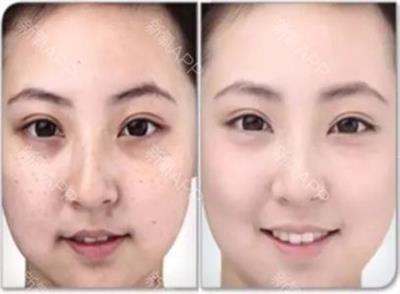 药水祛雀斑好还是激光祛雀斑好,激光祛雀斑最有效的方法