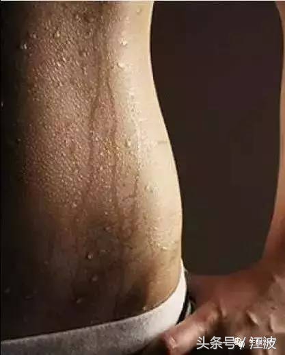 生酮过程皮肤瘙痒怎么办,生酮浑身痒