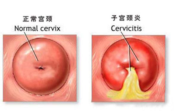 夏日炎炎女性如何预防妇科疾病,女性预防妇科炎症吃什么药