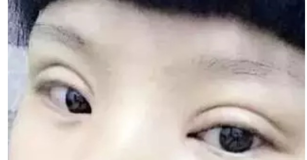 做双眼皮一个星期后感觉太宽了,第一次做双眼皮太窄了