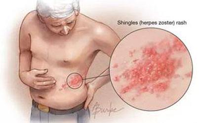 带状疱疹影响视力咋办,鼻子上长带状疱疹咋办