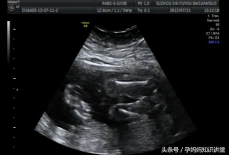 孕四个月的b超图怎么看,怎么看b超单判断胎儿怀孕