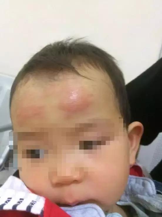 儿童退烧贴额头不让贴贴哪里,女儿用退热贴