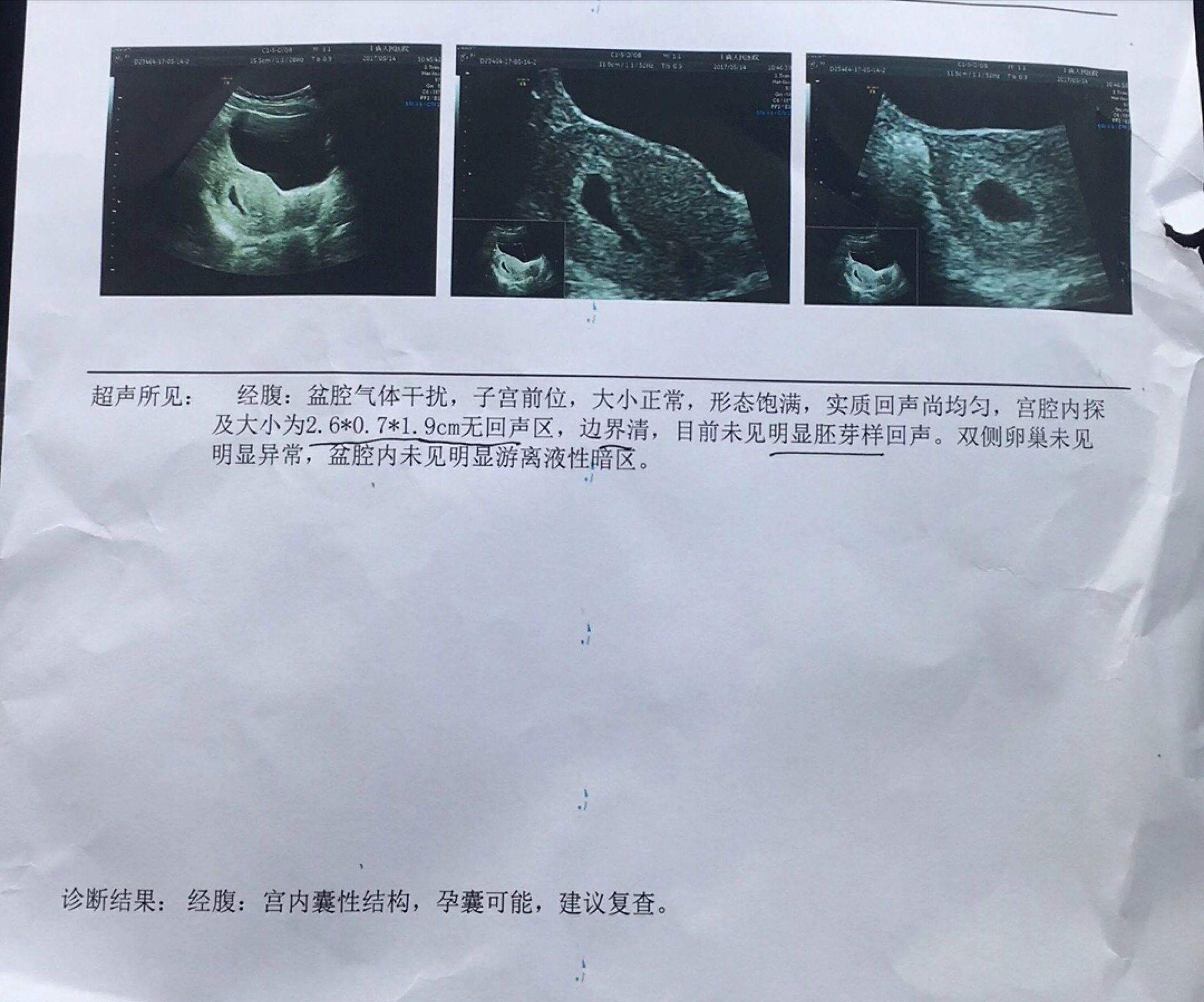 幸运降临，提心吊胆妈妈怀孕历程