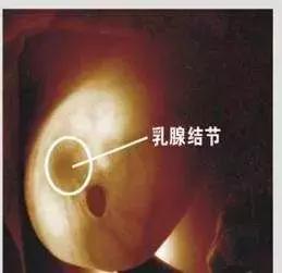 乳腺小叶增生钙化什么毛病,怀孕了小叶增生结节会加重吗