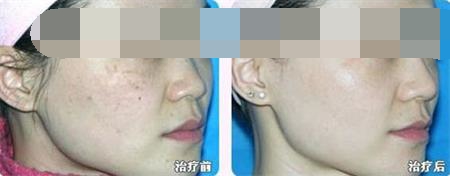 激光祛雀斑的效果好吗,翠绿宝石755nm激光祛雀斑的作用