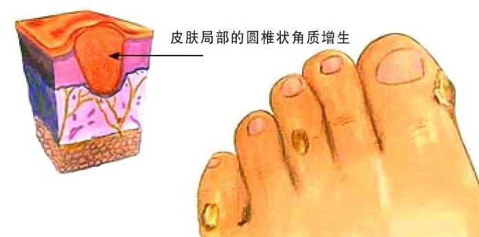 医院治不好鸡眼,发现鸡眼怎么治