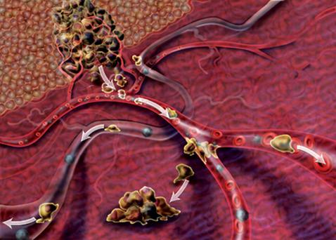 癌症早期治疗器械,最新治疗癌症的方法