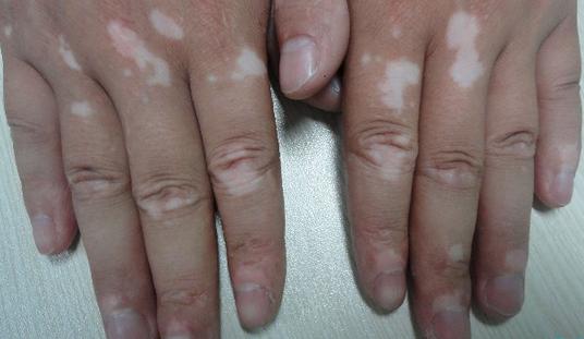 白癜风患者可以刮痧拔罐吗,白癜风处刮痧有好处吗