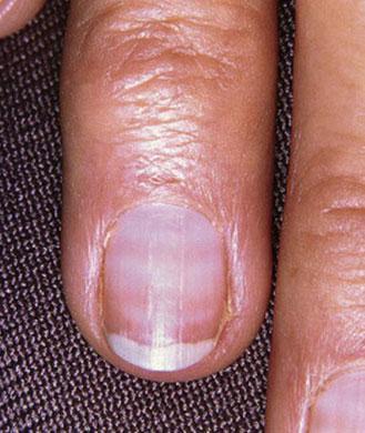 一般来说健康的指甲是什么样子,健康指甲的正常颜色