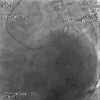 急性心肌梗死心源性休克时的处理,急性心肌梗死心源性休克最常见