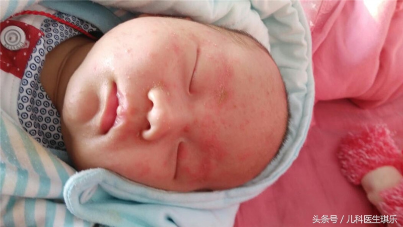 康复新液可以治疗湿疹吗,湿疹感染溃烂可以用康复新液吗