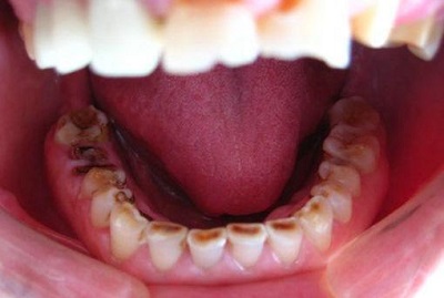 你知道缺牙的后果有多严重吗,你真的知道缺牙的危害