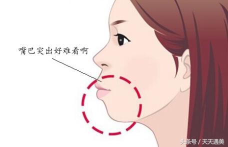 凸嘴到底有多可怕,突嘴是牙齿原因吗