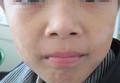 小孩身上有一块白斑怎么回事,天冷身上会有白斑什么情况