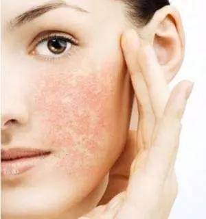 夏天用防晒产品过敏,皮肤过敏还有点痒能用防晒霜吗