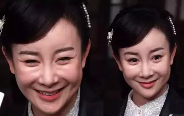 注射的玻尿酸是被人体吸收了吗,注射玻尿酸肿胀感多长时间消失