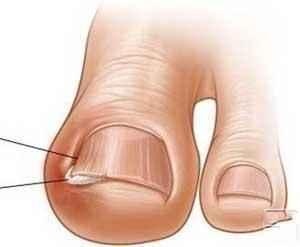 脚趾甲往肉里长很痒怎么办,大拇脚趾肉里痒怎么办