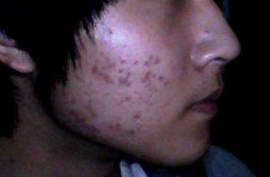 台州消除青春痘疤痕,男士青春痘疤痕怎么修复