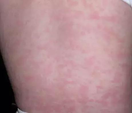 湿疹皮肤用药大全手册,湿疹性皮炎宣教