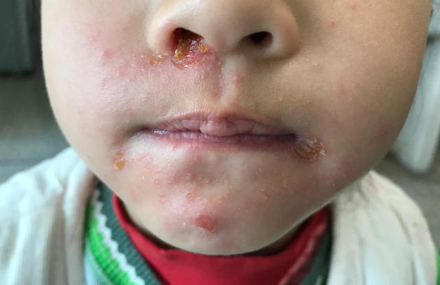 原来黄水疮有传染性,如何正确治疗呢?