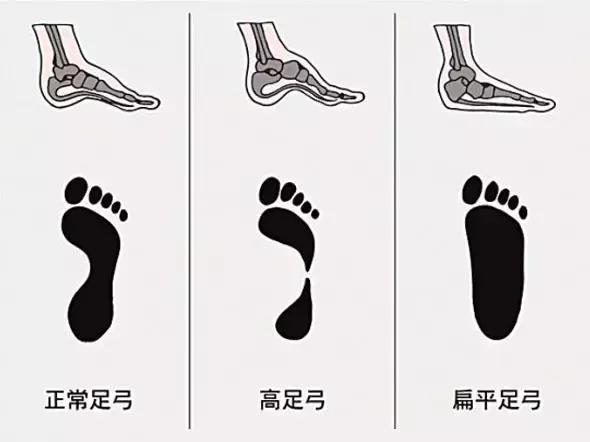 足弓和脚后跟痛怎么回事,长期走路脚掌痛鞋垫软还是硬