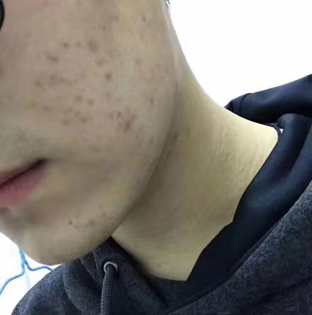 如何预防长痘和祛痘,怎么防止闷痘变脓痘