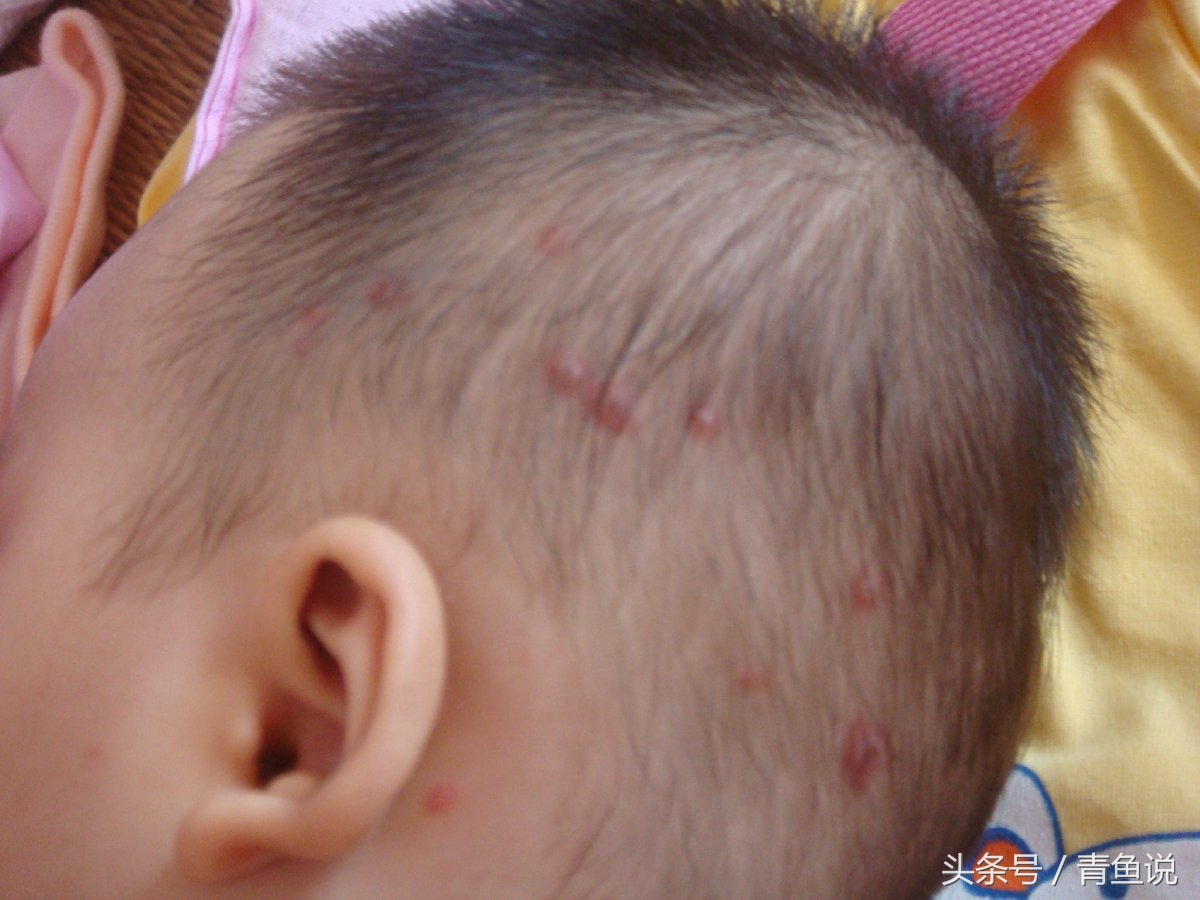 婴儿颈部出现红疹子该怎么办,颈部有红疹子用什么药好得快