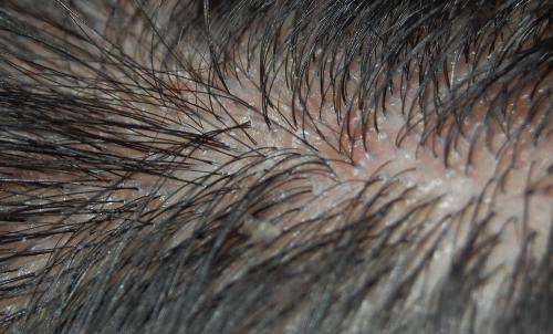 头皮毛囊炎用什么洗头好,头皮毛囊炎反复用什么洗头