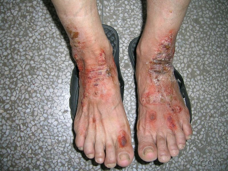 压疮久治不愈后果,身体压疮怎么治疗