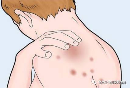 「科普专栏」皮肤病康复科普系列之——红蓝光治疗仪