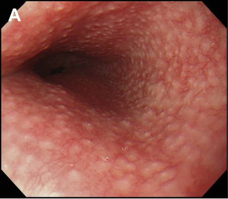 腹泻的不同类型及病例,腹泻的不同原因及现象