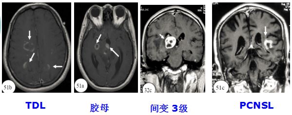 医学干货：瘤样炎性脱髓鞘病与胶质瘤、PCNSL临床、影像鉴别