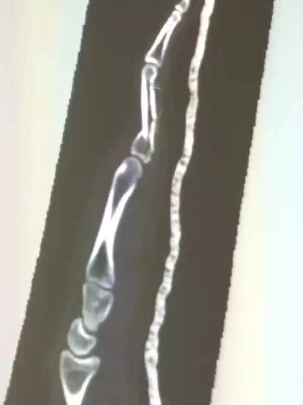 快转!你手机背后有这个东西吗?太多人在用,有人被它弄折了手指!