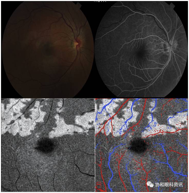 文摘速递丨横看成岭侧成峰,BC扫描各不同—PAMM的enface-OCT影像