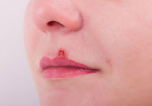 嘴唇红肿干燥起皮怎么回事,嘴唇发红干裂起皮怎么办