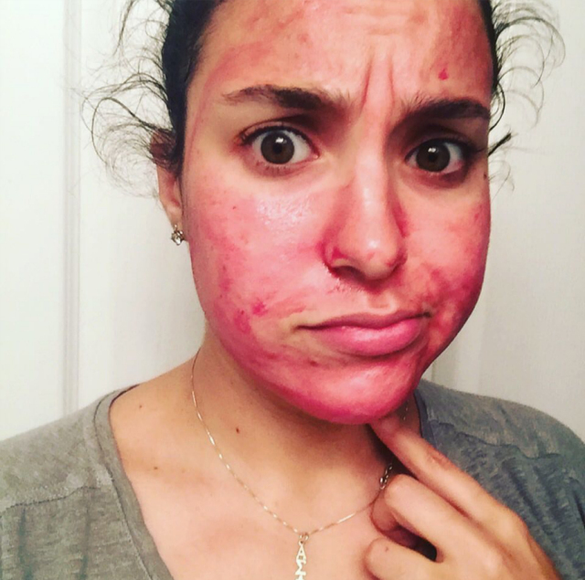 祛痘祛闭口粉刺黑头,如何有效的祛痘去黑头去闭口