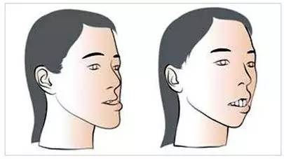 2岁儿童牙齿反颌矫正方法图片,12岁前必须矫正牙颌畸形吗