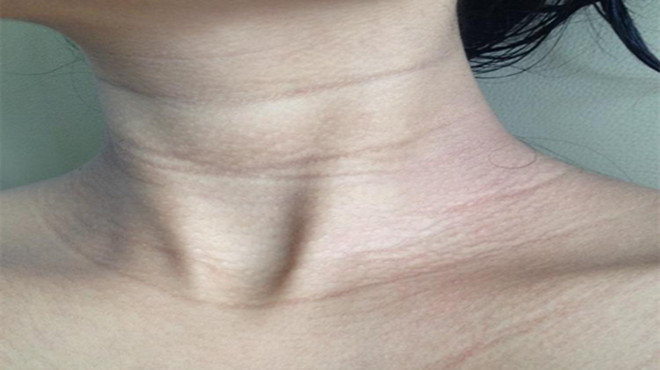 颈部有皱纹怎么可以改善,睡觉面部压出皱纹与枕头有关系吗