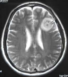 非小细胞肺癌脑转移用什么靶向药 (小细胞肺癌脑转移吃什么靶向药)