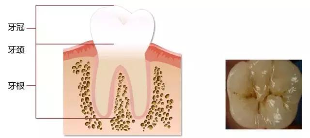 龋齿属于虫牙吗,蛀牙龋齿虫牙是怎么形成的