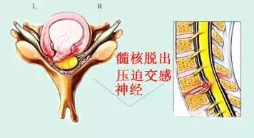 颈椎病分7种快来看看你是哪一类,颈椎病常见的这五种分型您了解吗