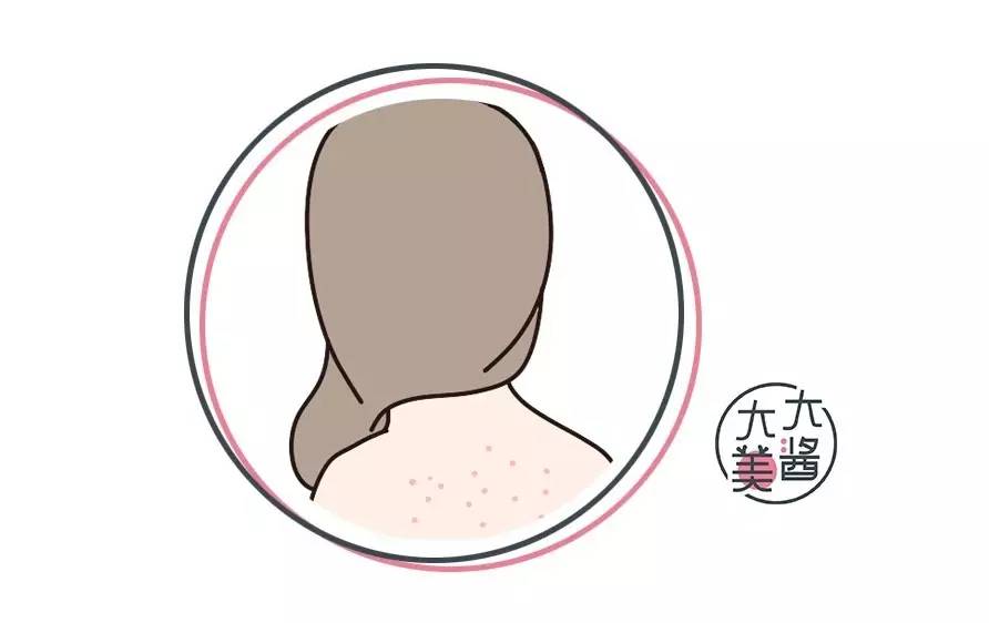 第二天要穿吊带如何解决背后痘痘,后背有痘痘穿吊带的急救办法