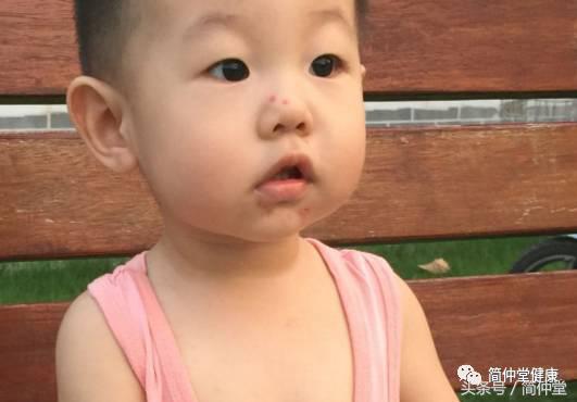 火疖子是什么样子的图片,火疖子是什么引起的